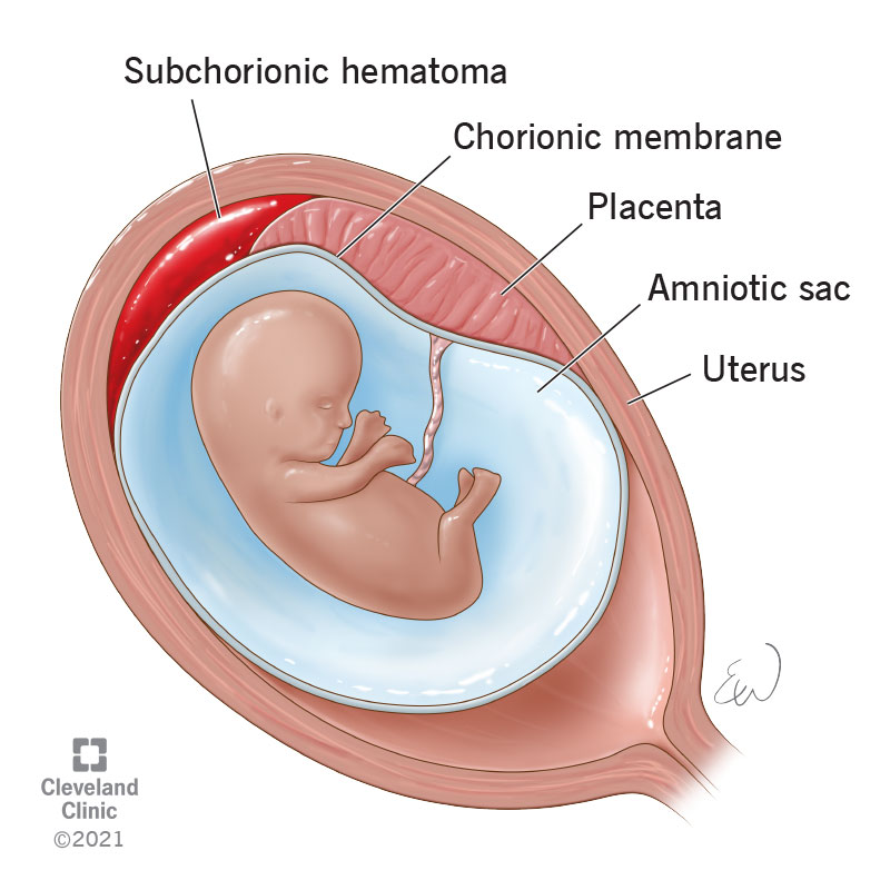 Read more about the article Subchorionic Hematoma: Causes, Symptoms & Treatment